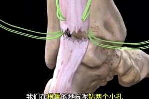 看著都疼啊????科普帖：球員腳跟腱斷裂是如何進(jìn)行修復(fù)的？