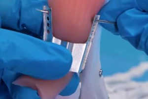 運(yùn)動(dòng)員們的跟腱都是怎么修復(fù)的？這么看起來真的太辛苦了